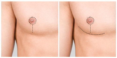 Incision 5 et 6